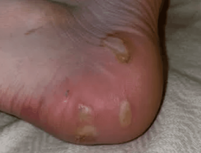 Blisters from standard combat boots