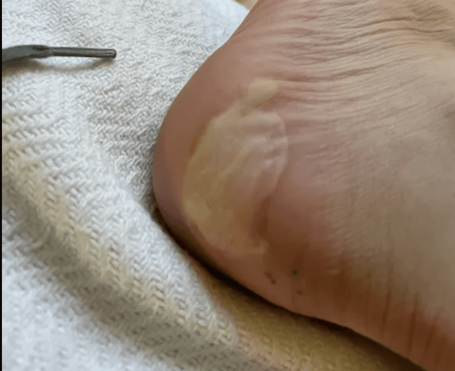 Blisters from standard combat boots